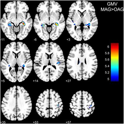 Comparison between morphometry and radiomics: detecting normal brain aging based on grey matter